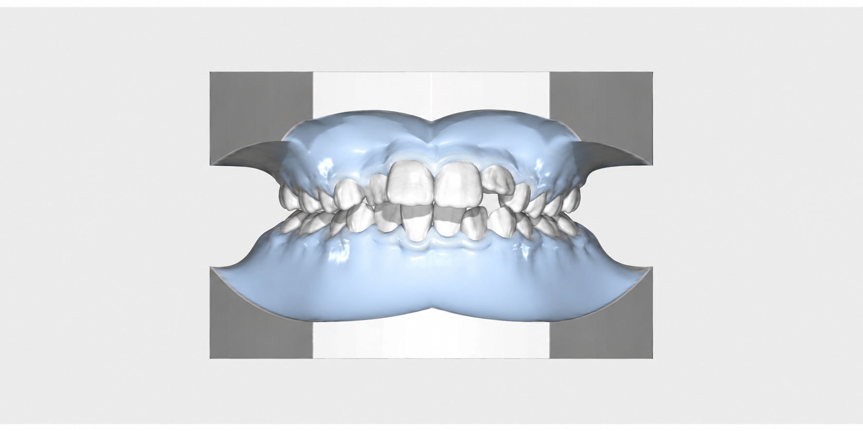 3D-Darstellung eines Zahnmodells mit Zahnengstand vor einer kieferorthopädischen Behandlung